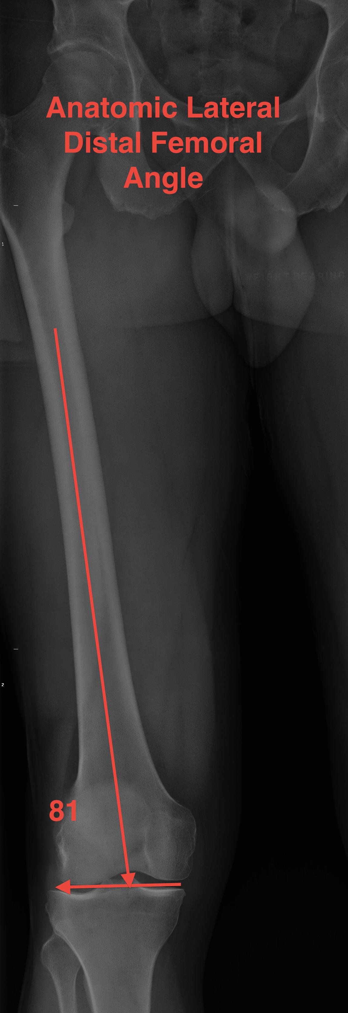 Anatomic Lateral Distal Femoral Angle